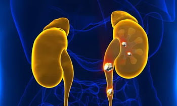 How can you tell if you have kidney stones