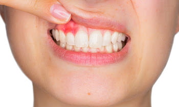 How to Reverse Periodontal Disease Naturally: Top 10 Strategies for Oral Health