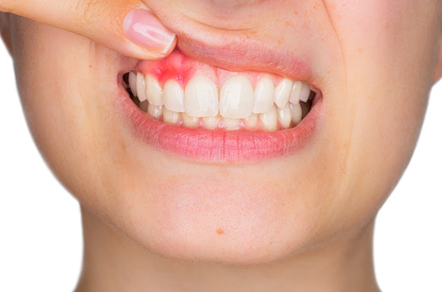 how to reverse periodontal disease naturally